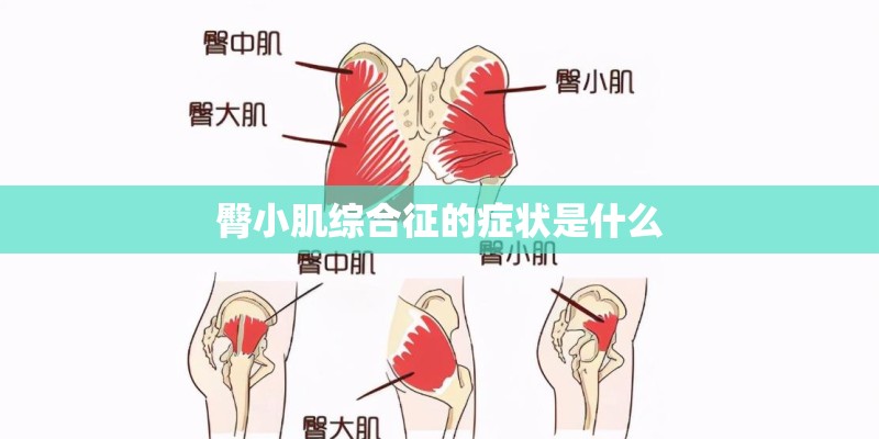 臀小肌综合征的症状是什么